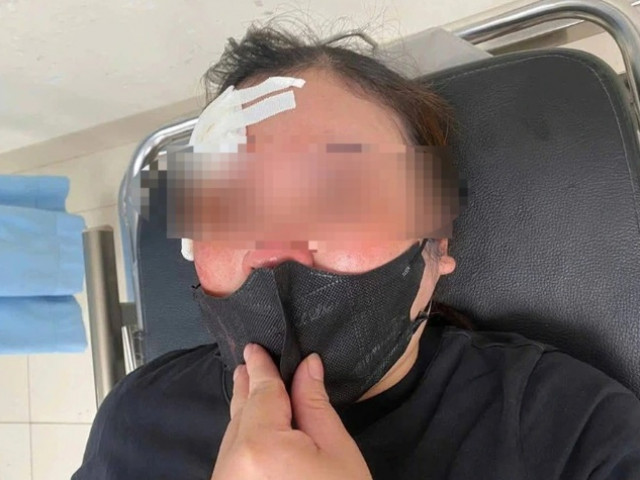 Hà Nội: Dừng nghe điện thoại bên đường, người phụ nữ bị tài xế ô tô dùng dùi cui đập vào đầu